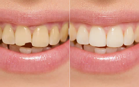 Cosmetic Bonding For Our Bedford Patients