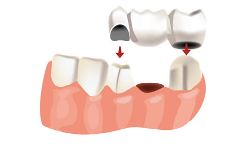 Treatment For Gaps Between Your Teeth In Bedford